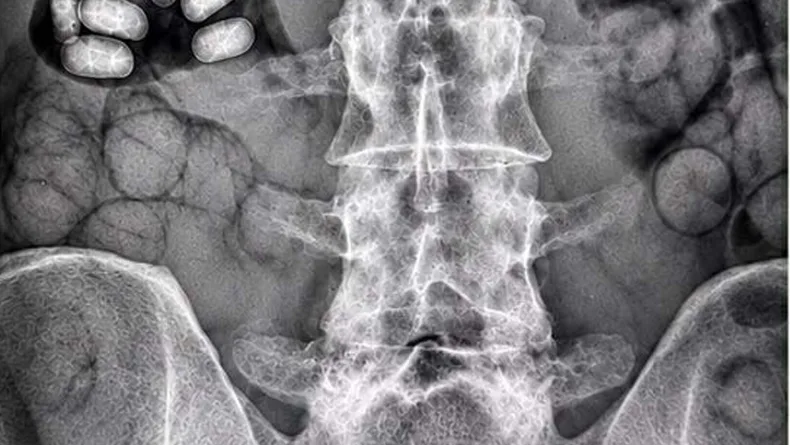 Havalimanında şüpheli 2 yolcunun midelerinden 495 gram metamfetamin çıktı