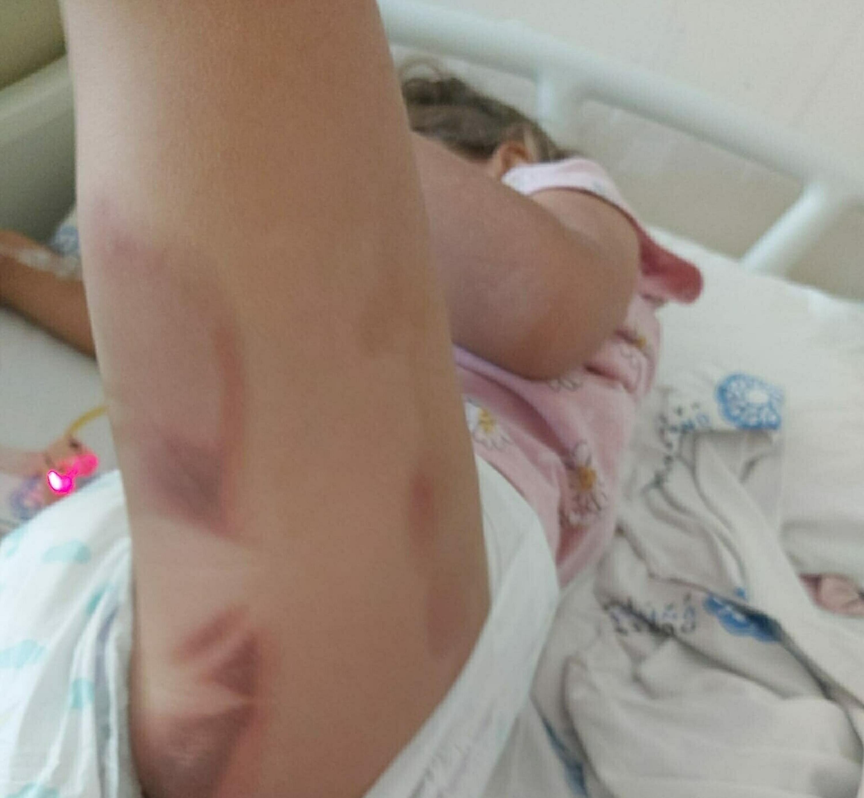 3 yaşındaki Yaren ameliyattan yanık izleriyle çıktı, aile