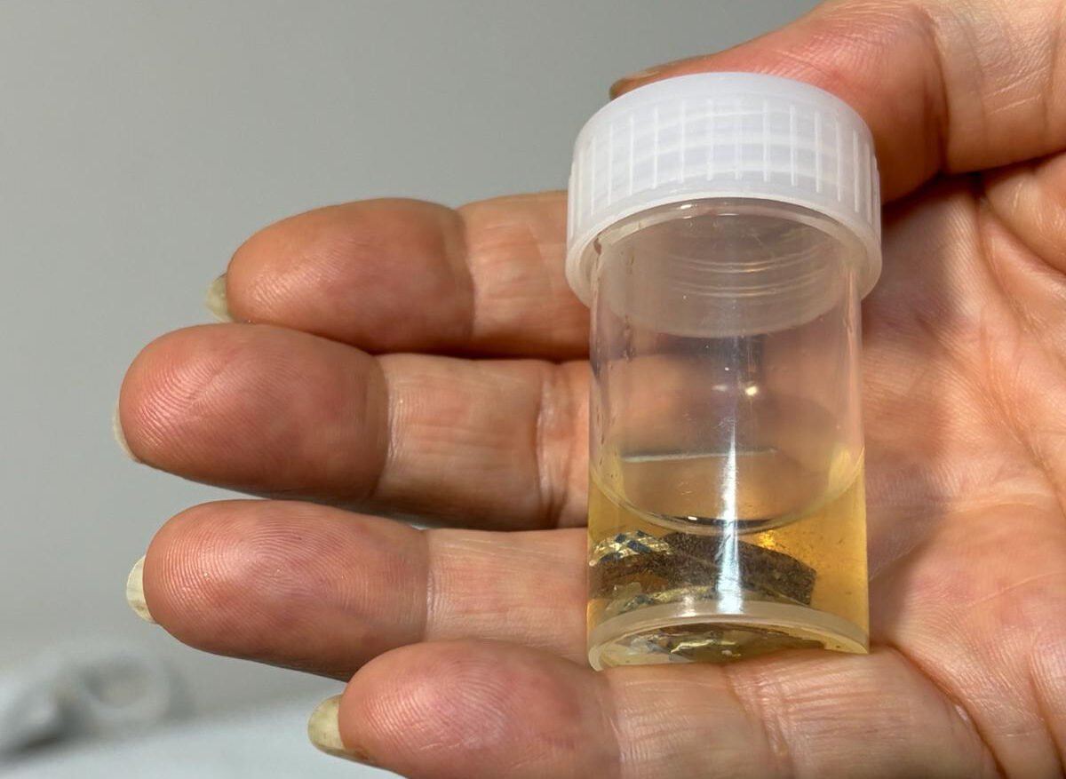 Alüminyum kabıyla yuttuğu hap, 4 yıl sonra akciğerinden ç.