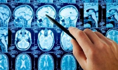 Beyin Tümörü Nedir, Tedavisi Nasıl Yapılır?