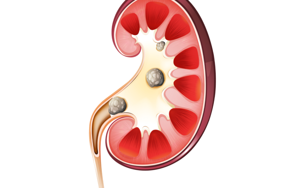 Böbrek taşı nasıl oluşur?