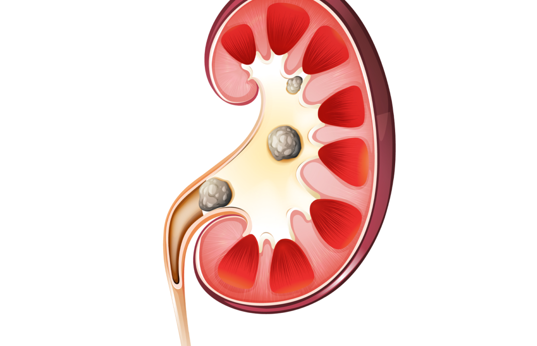 Bobrek tasi nasil olusur e1685048398422