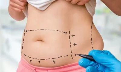 Liposuction nedir, kimler yaptırabilir, nasıl uygulanır?