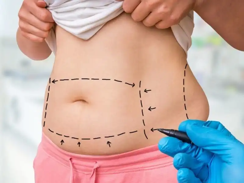 Liposuction nedir, kimler yaptırabilir, nasıl uygulanır?