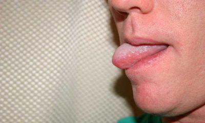 Dildeki yaralar kanser belirtisi olabilir