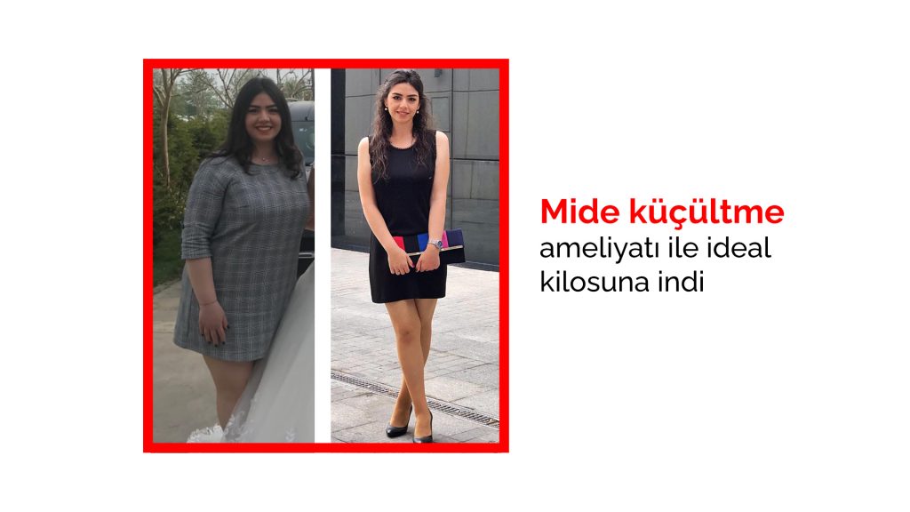 Mide küçültme ameliyatı ile ideal kilosuna indiMide küçültme ameliyatı ile ideal kilosuna indi