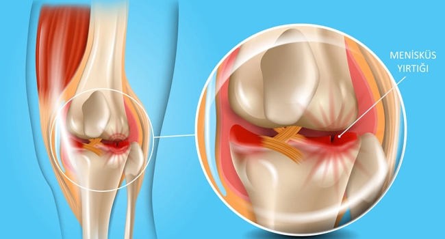 Menisküs yırtığı nasıl olur? Tedavisi nasıl yapılır?