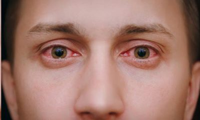 Göz alerjisi nedir, nasıl tedavi edilir?